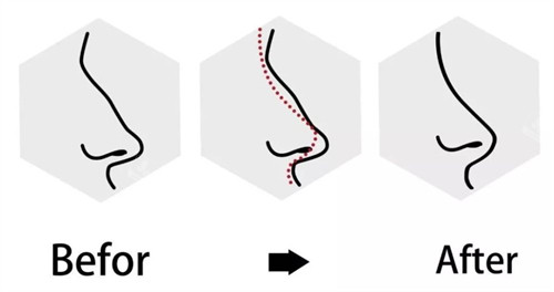 鼻修复术前术后对比图