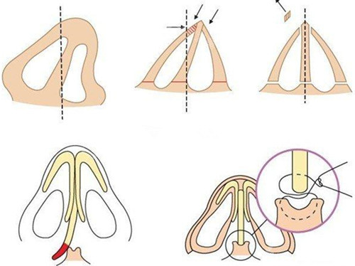 歪鼻修復(fù)術(shù)前術(shù)后圖