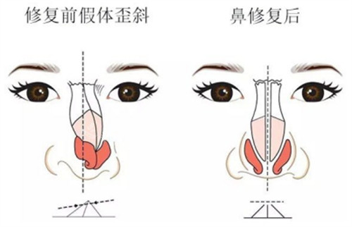 假体歪斜修复前后示意图