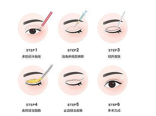 双眼皮流程图 双眼皮流程图