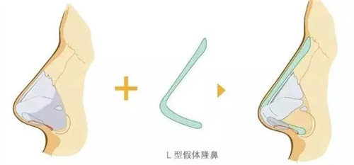 L型假体动画展示图 L型假体动画展示图