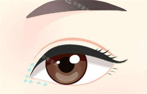 开眼角修复动画图 开眼角修复动画图