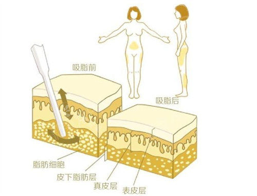 抽脂前后动画对比图 抽脂前后动画对比图