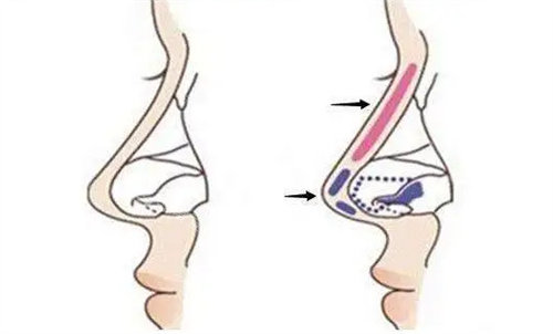 隆鼻结构细节展示图