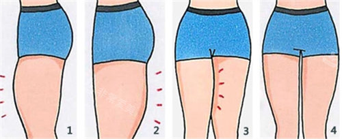 吸脂瘦大腿动画图 吸脂瘦大腿动画图