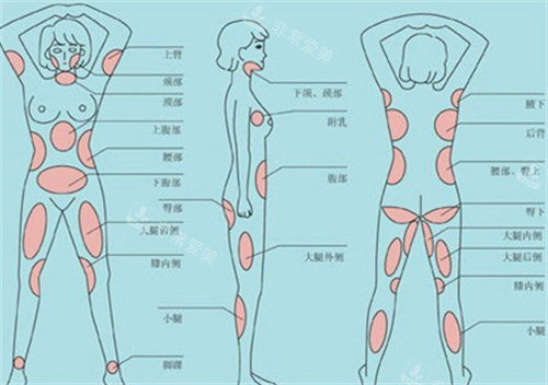 可吸脂部位展示图 可吸脂部位展示图