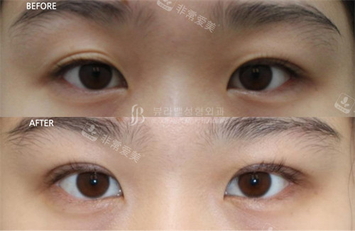 韩国Beulibal整形外科眼修复前后对比照