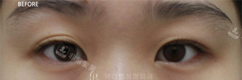 韩国Beulibal整形外科眼修复术前照片