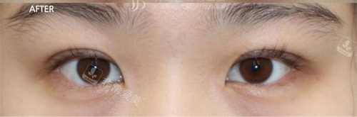 韩国Beulibal整形外科眼修复术后一个月照片