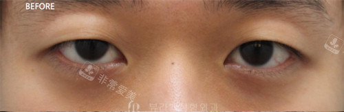 韩国Beulibal整形外科眼修复术前照片