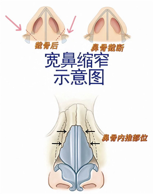 宽鼻缩窄示意图