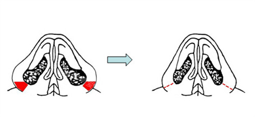鼻翼縮小示意圖