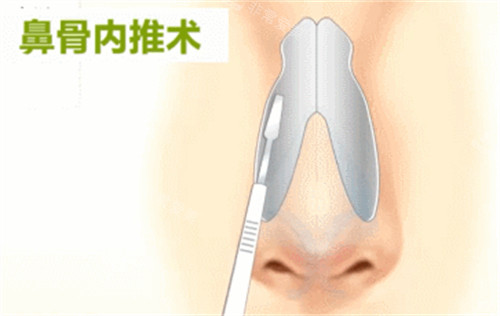 鼻骨內(nèi)推示意圖