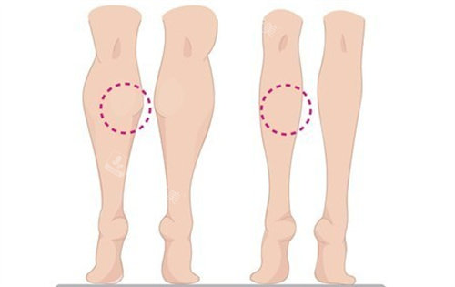 韩国瘦小腿手术整形医院，明白人都选择波轮美整形外科！