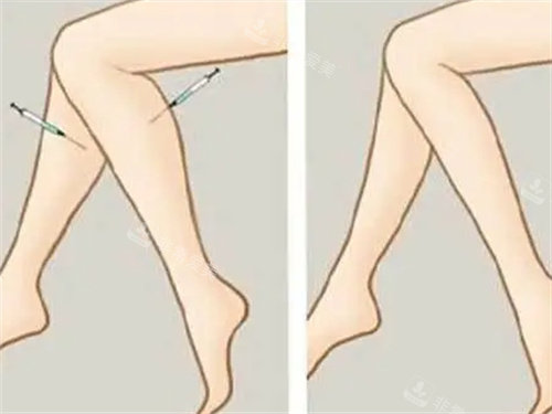 針劑注射瘦小腿動(dòng)畫(huà)圖