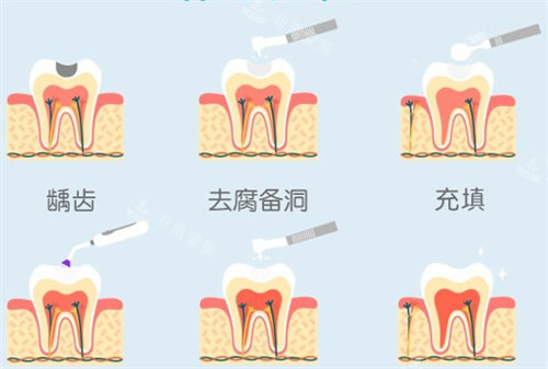 补牙流程图 补牙流程图