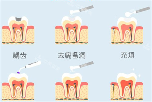补牙流程图