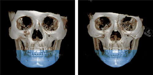韩国绮林整形外科下颌角整形对比照