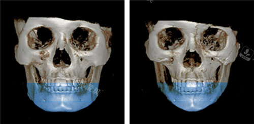 韓國(guó)綺林整形外科下頜角整形對(duì)比照