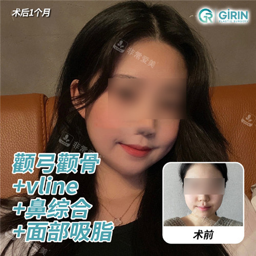 韓國綺林整形外科整形前后對比照 韓國綺林整形外科整形前后對比照