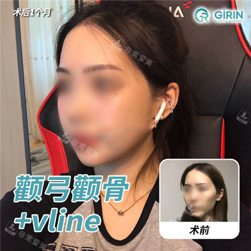 韓國綺林整形外科面部輪廓整形對比圖 韓國綺林整形外科面部輪廓整形對比圖