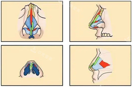 鼻子整形手术解剖图