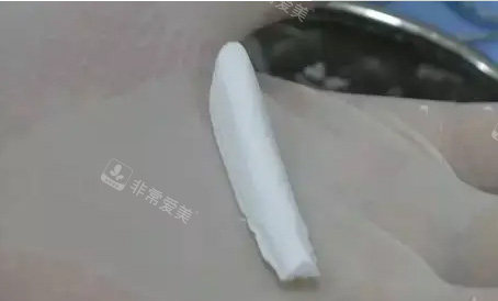 隆鼻假体照片