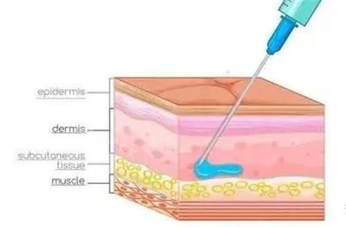 玻尿酸填充动画图