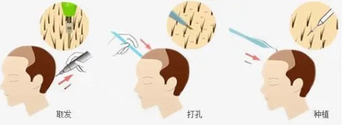 植發(fā)示意圖 植發(fā)示意圖