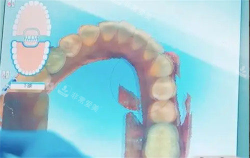 牙齒矯正數(shù)字化設(shè)計(jì)圖