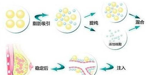 脂肪填充操作圖