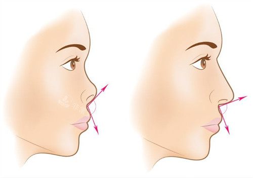 朝天鼻矫正示意图