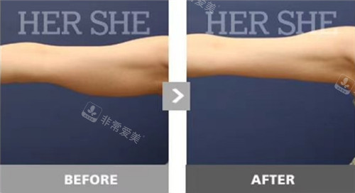 韩国赫尔希整形外科手臂吸脂对比照