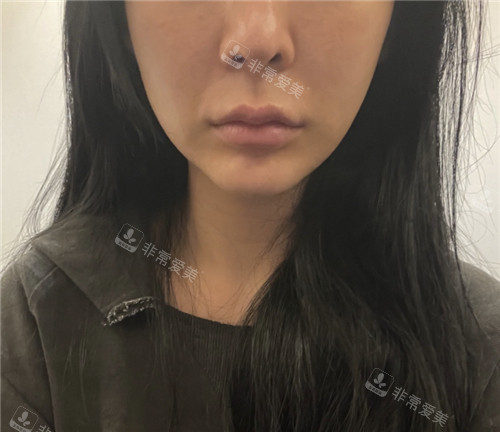 韓國赫爾希整形外科秘密水滴提升術(shù)前 韓國赫爾希整形外科秘密水滴提升術(shù)前