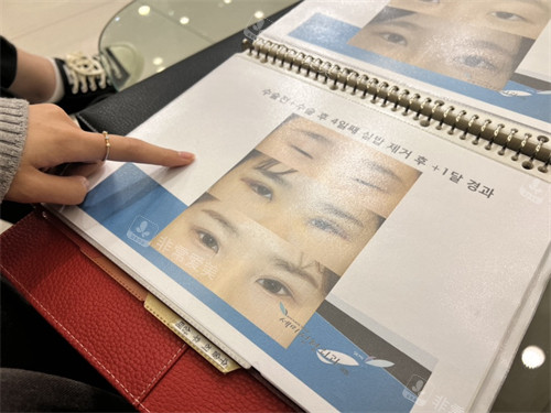 韩国世美整形外科真人例子图册展示