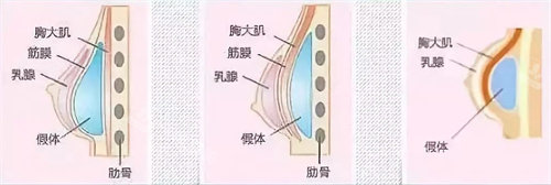 假体隆胸位置图