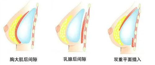 假體隆胸植入位置示意圖 假體隆胸植入位置示意圖
