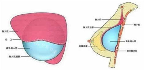 假体与胸部组织图