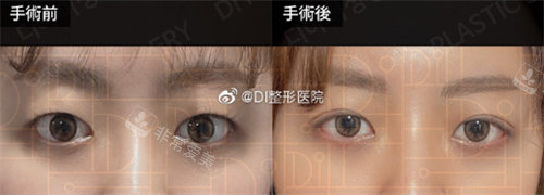 雙眼皮術(shù)前術(shù)后對比圖