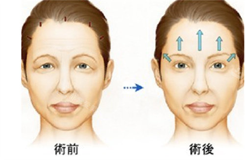 拉皮手術(shù)動(dòng)畫對(duì)比圖
