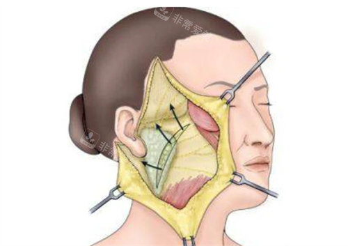 大拉皮手术切口展示图