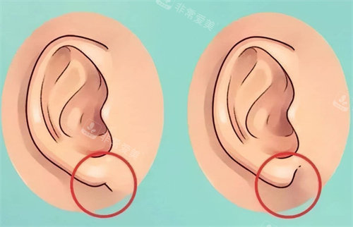 耳垂的不同形態(tài)對(duì)比圖 耳垂的不同形態(tài)對(duì)比圖