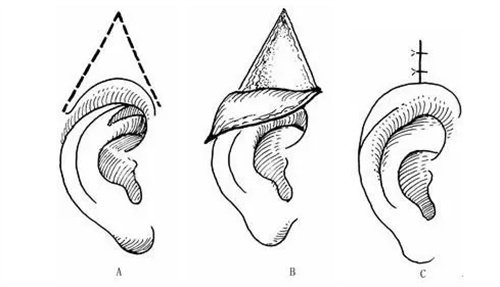 耳再造直埋法展示图