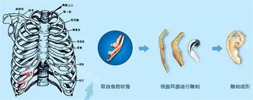 耳再造手術(shù)流程圖 耳再造手術(shù)流程圖
