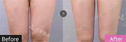 SNOW整形醫(yī)院大腿環(huán)吸360度+膝蓋內(nèi)側(cè)吸脂手術(shù) SNOW整形醫(yī)院大腿環(huán)吸360度+膝蓋內(nèi)側(cè)吸脂手術(shù)