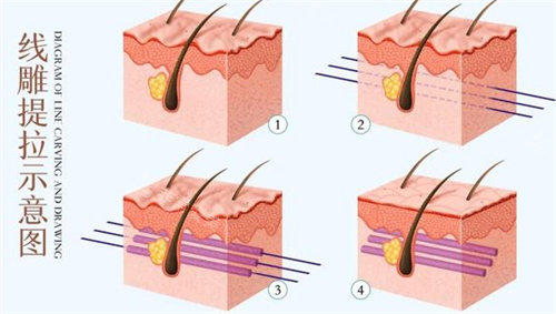 埋线提升术图片