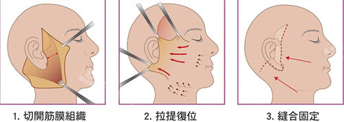 拉皮手術(shù)示意圖