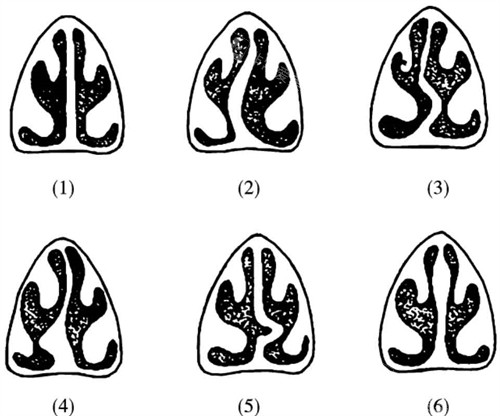 鼻中隔样式示意图