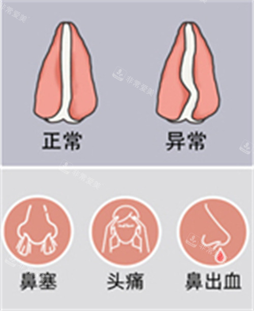 正常鼻中隔與異常鼻中隔對(duì)比圖