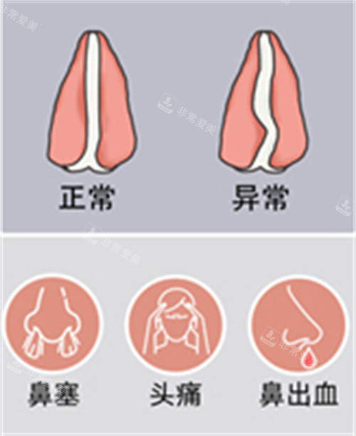 正常鼻中隔與異常鼻中隔對比圖